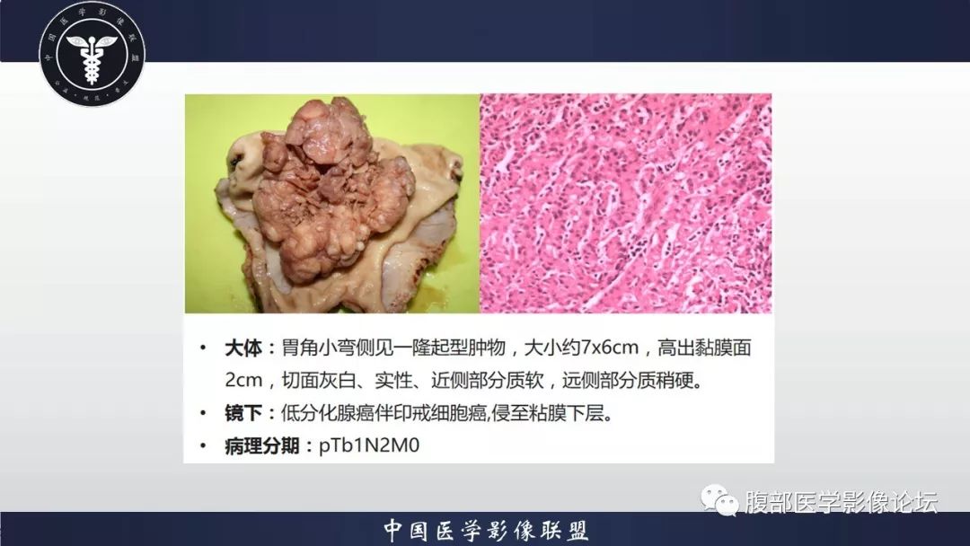【病例】胃癌1例CT影像