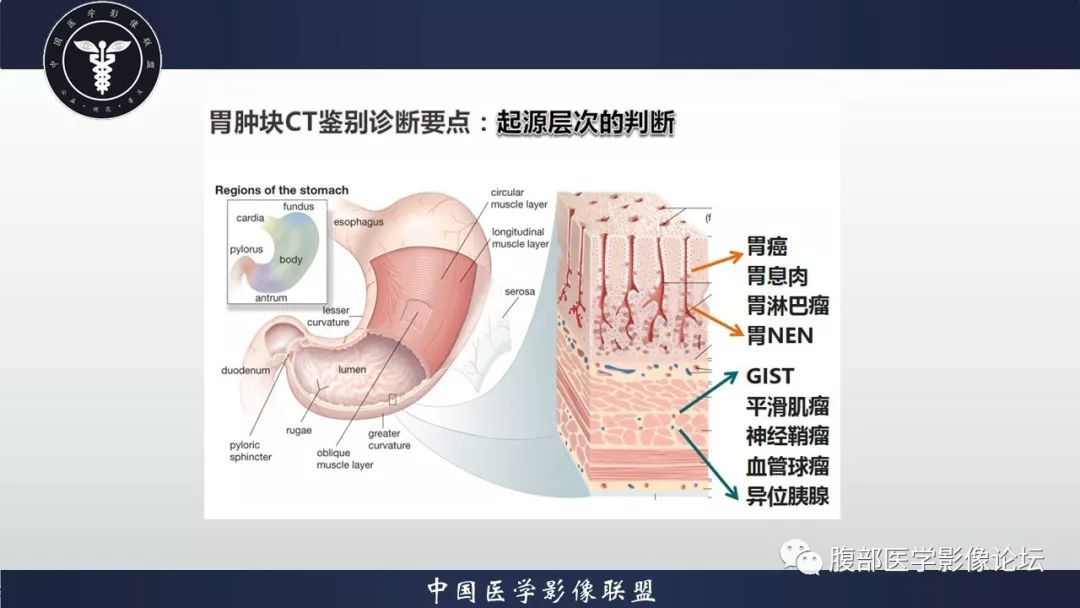 【病例】胃癌1例CT影像