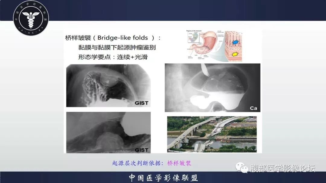 【病例】胃癌1例CT影像