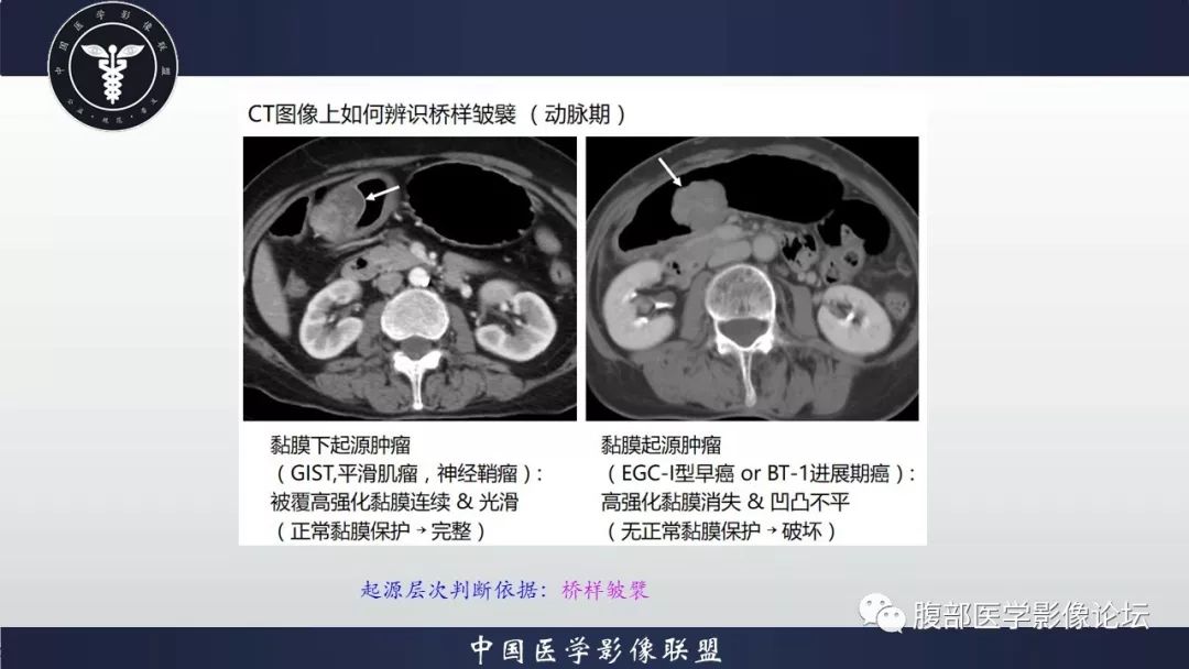 【病例】胃癌1例CT影像