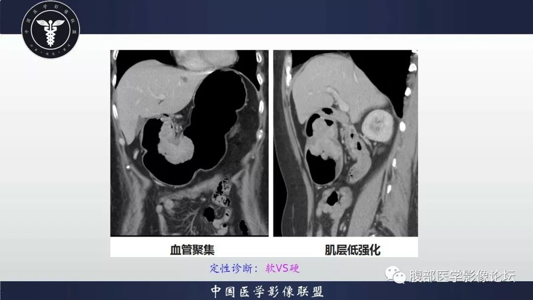 【病例】胃癌1例CT影像