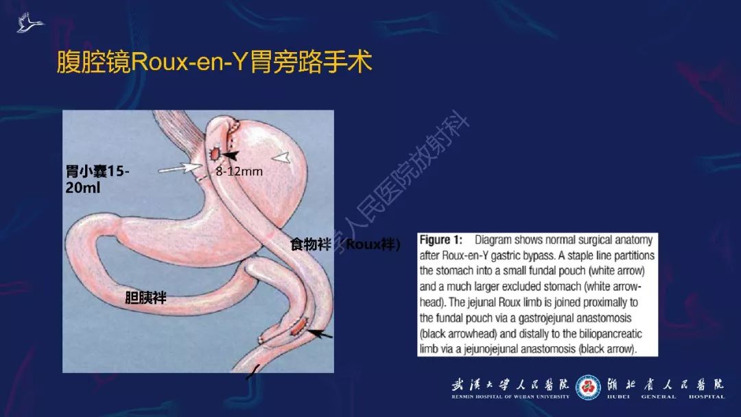 【PPT】减重术后正常表现及并发症影像诊断