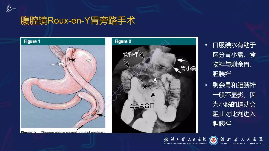 【PPT】减重术后正常表现及并发症影像诊断