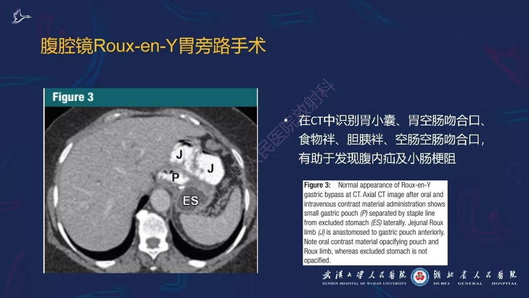 【PPT】减重术后正常表现及并发症影像诊断