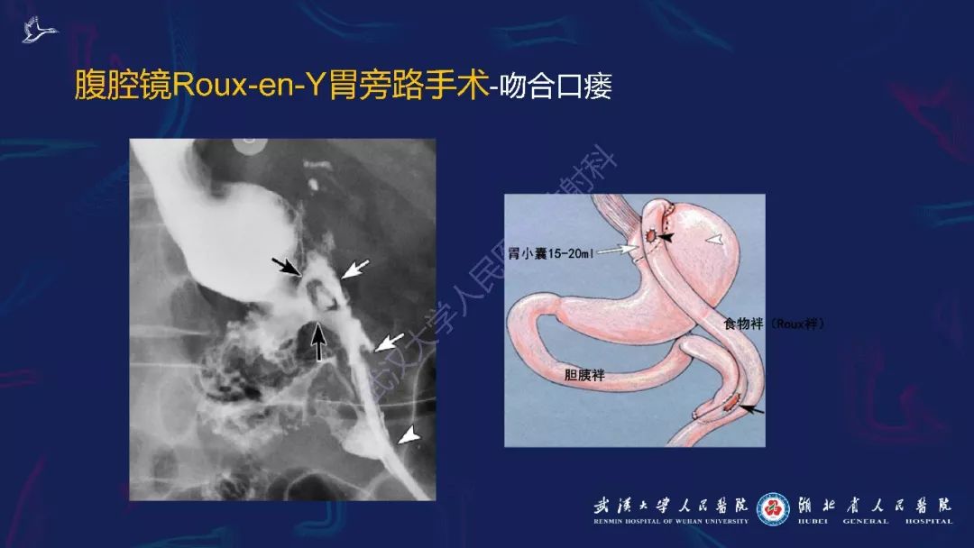 【PPT】减重术后正常表现及并发症影像诊断