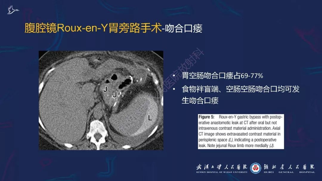 【PPT】减重术后正常表现及并发症影像诊断