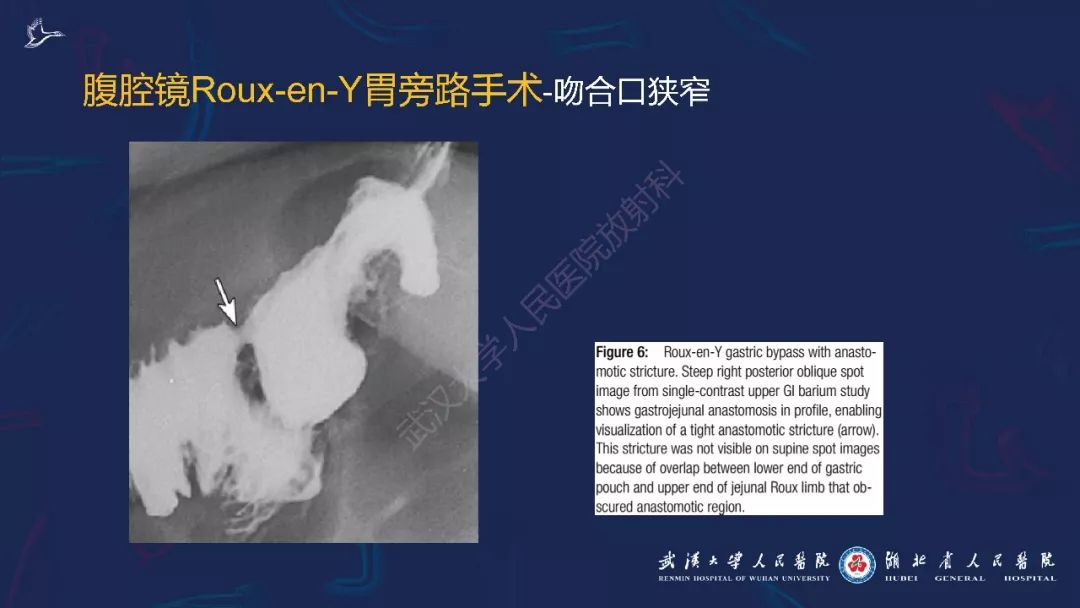 【PPT】减重术后正常表现及并发症影像诊断