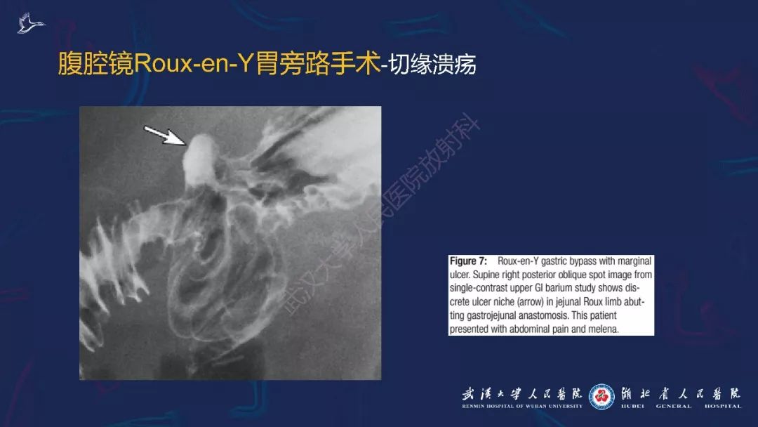 【PPT】减重术后正常表现及并发症影像诊断