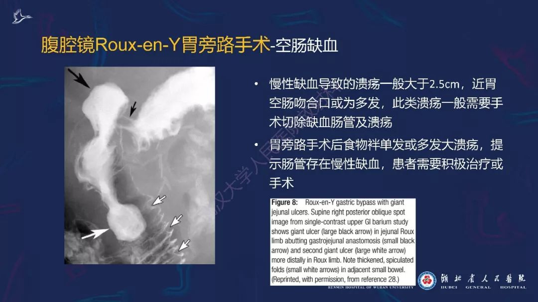 【PPT】减重术后正常表现及并发症影像诊断
