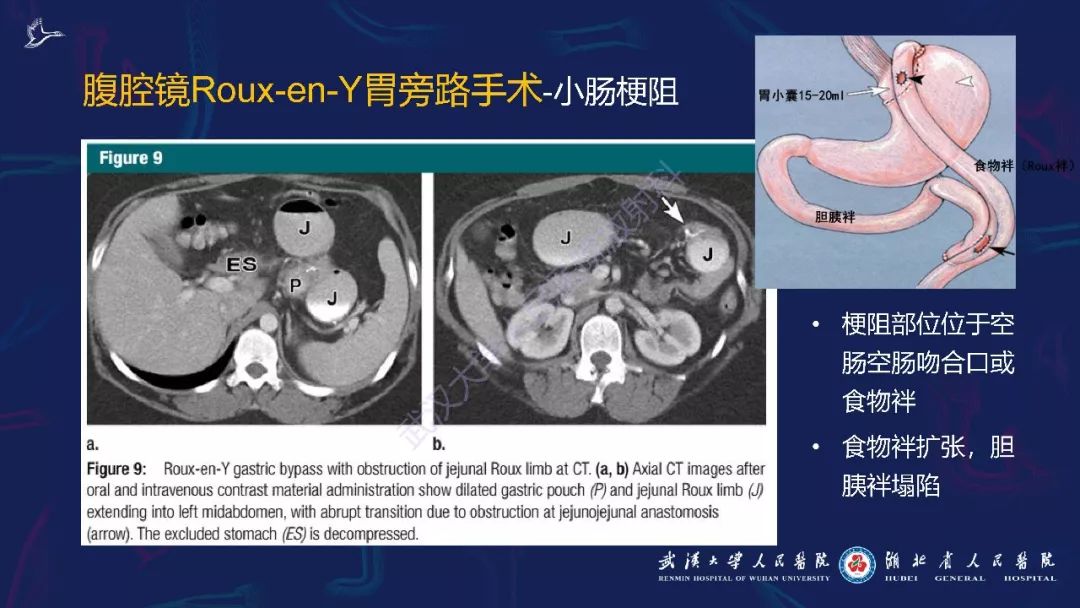 【PPT】减重术后正常表现及并发症影像诊断