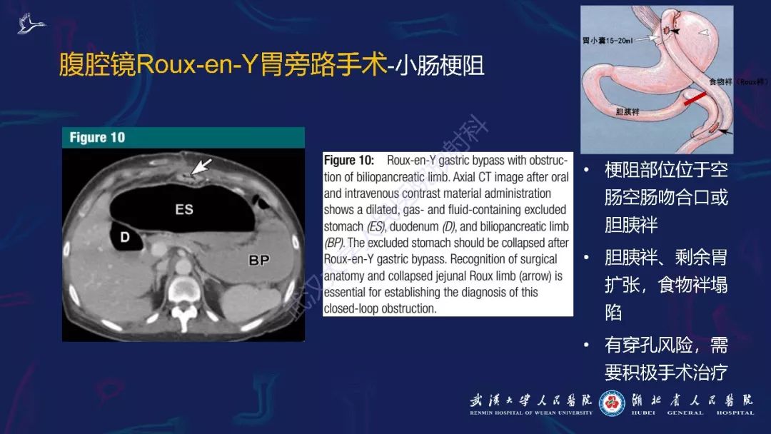 【PPT】减重术后正常表现及并发症影像诊断