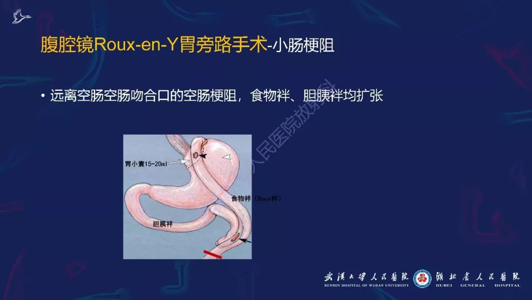 【PPT】减重术后正常表现及并发症影像诊断