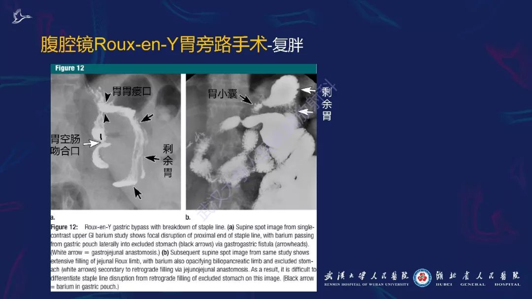 【PPT】减重术后正常表现及并发症影像诊断