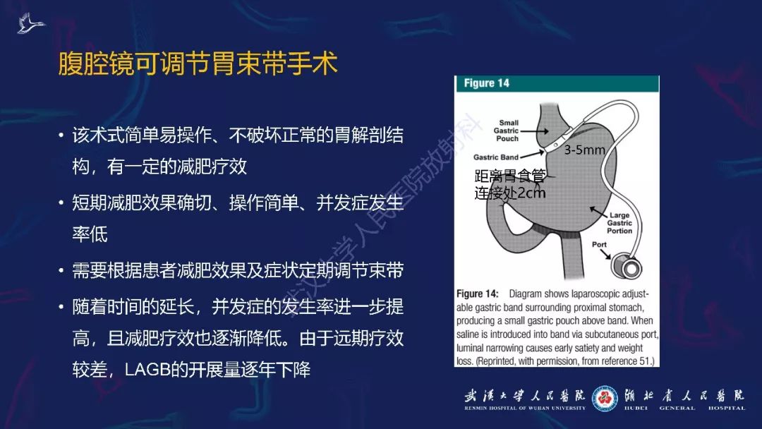 【PPT】减重术后正常表现及并发症影像诊断