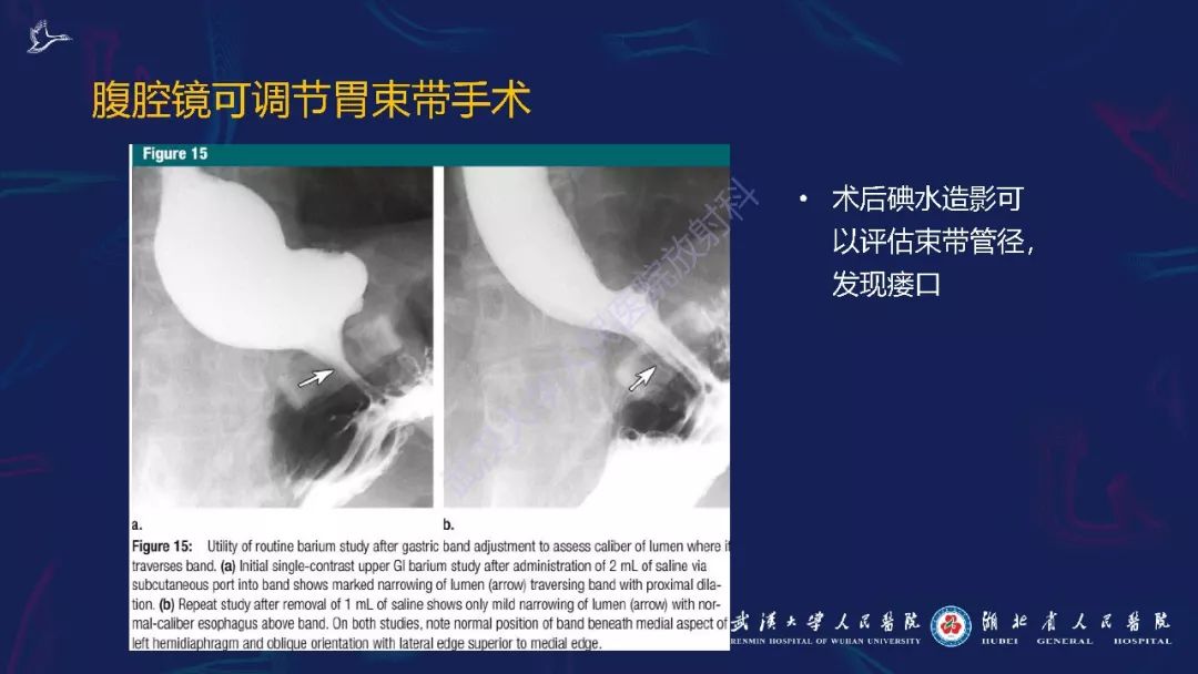 【PPT】减重术后正常表现及并发症影像诊断