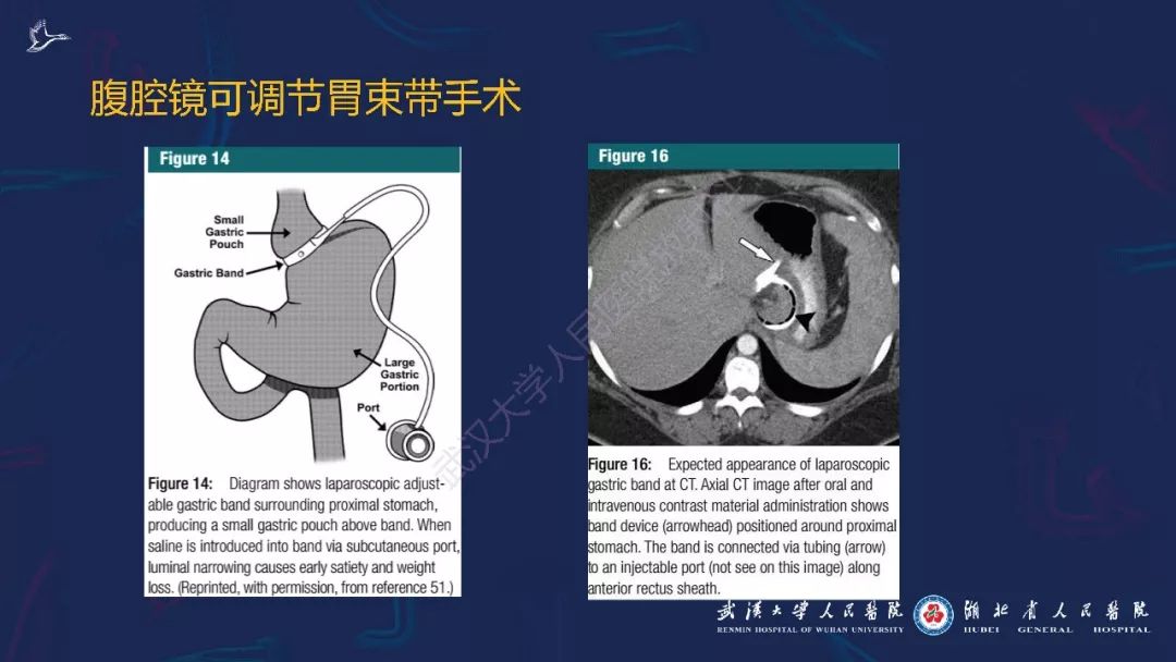 【PPT】减重术后正常表现及并发症影像诊断