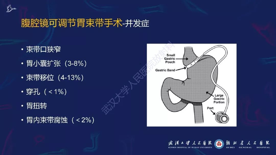 【PPT】减重术后正常表现及并发症影像诊断