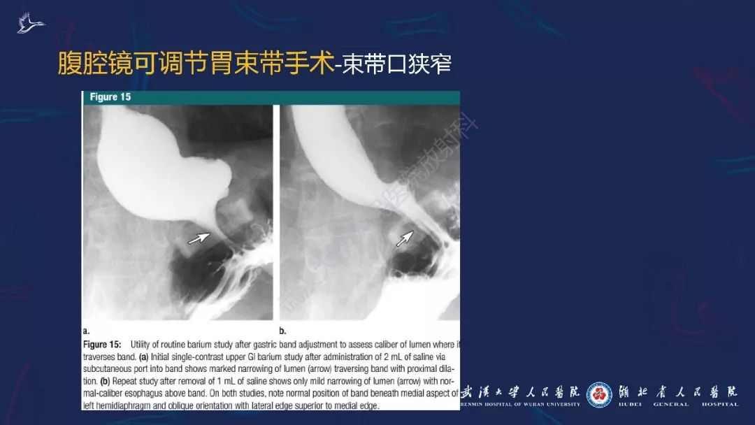 【PPT】减重术后正常表现及并发症影像诊断