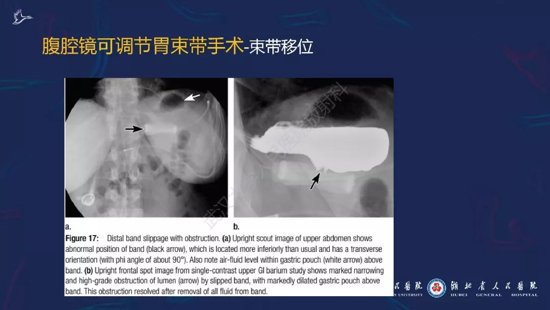 【PPT】减重术后正常表现及并发症影像诊断