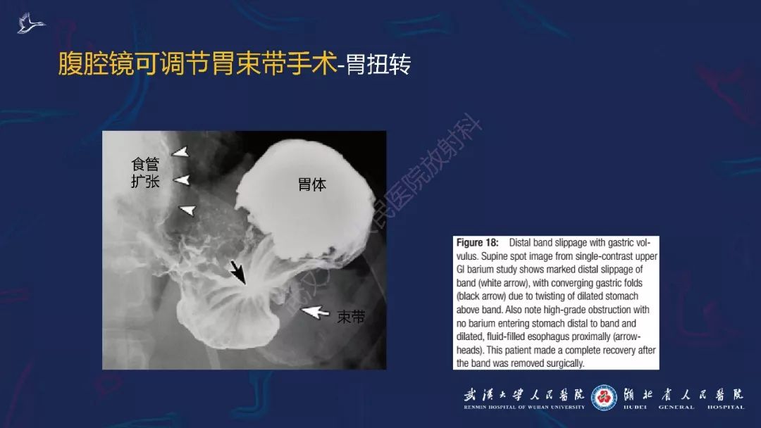 【PPT】减重术后正常表现及并发症影像诊断
