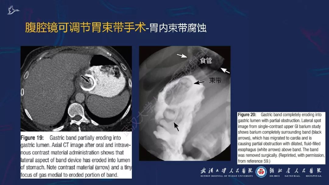 【PPT】减重术后正常表现及并发症影像诊断