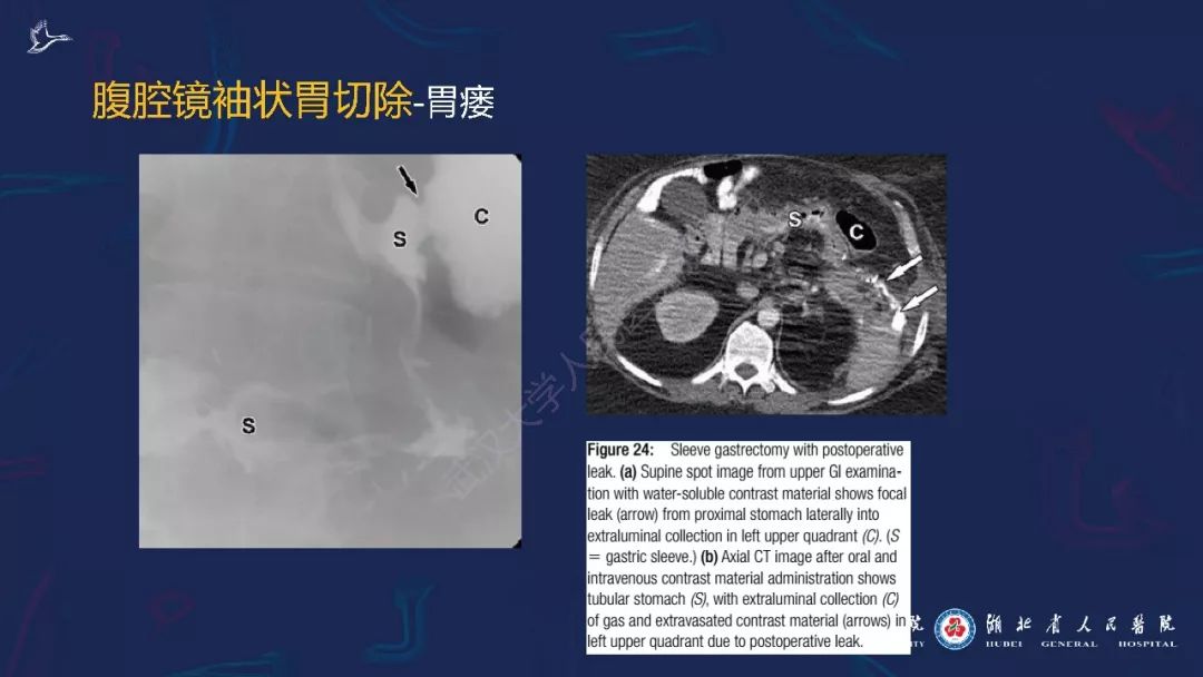 【PPT】减重术后正常表现及并发症影像诊断