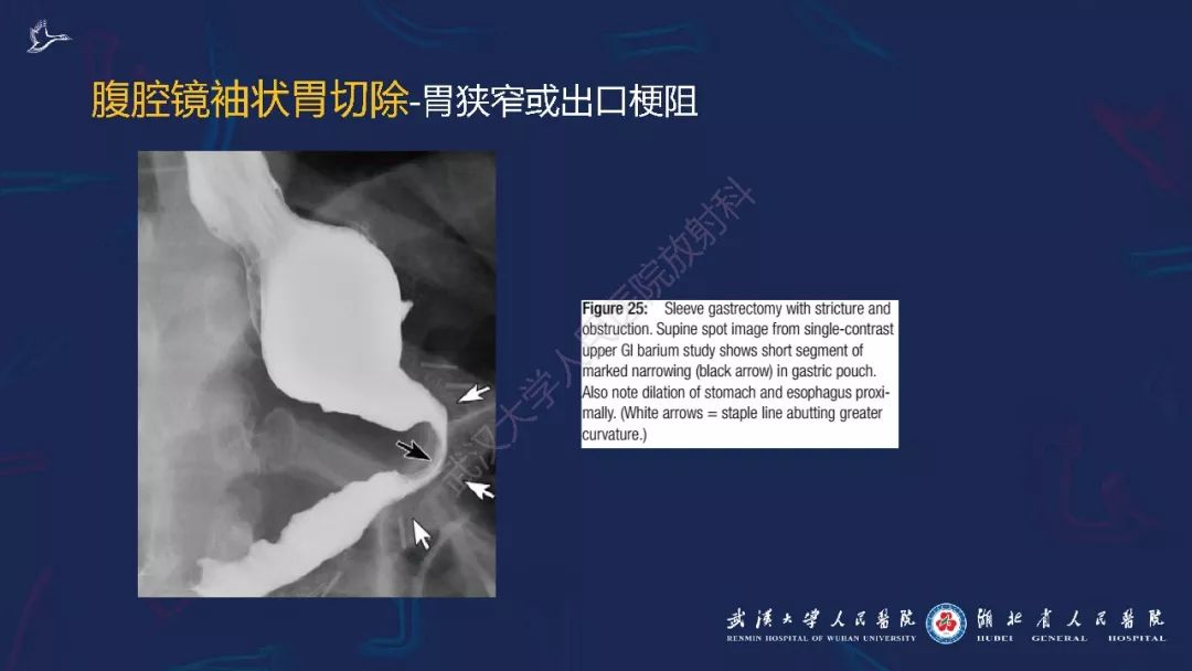 【PPT】减重术后正常表现及并发症影像诊断