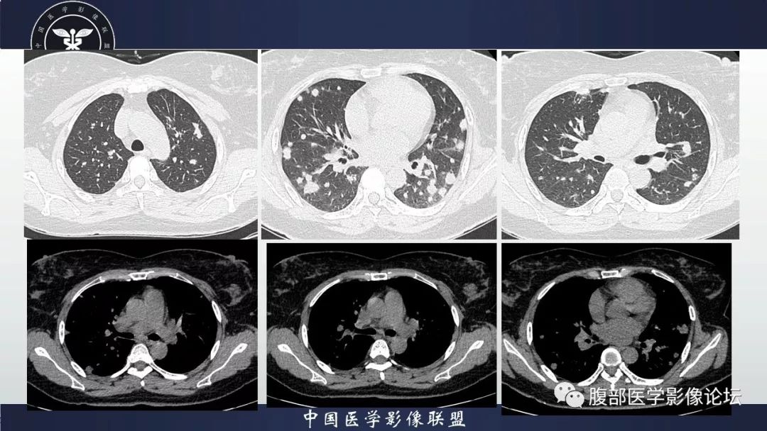 【病例】胰腺、肺结节病1例CT及MR影像