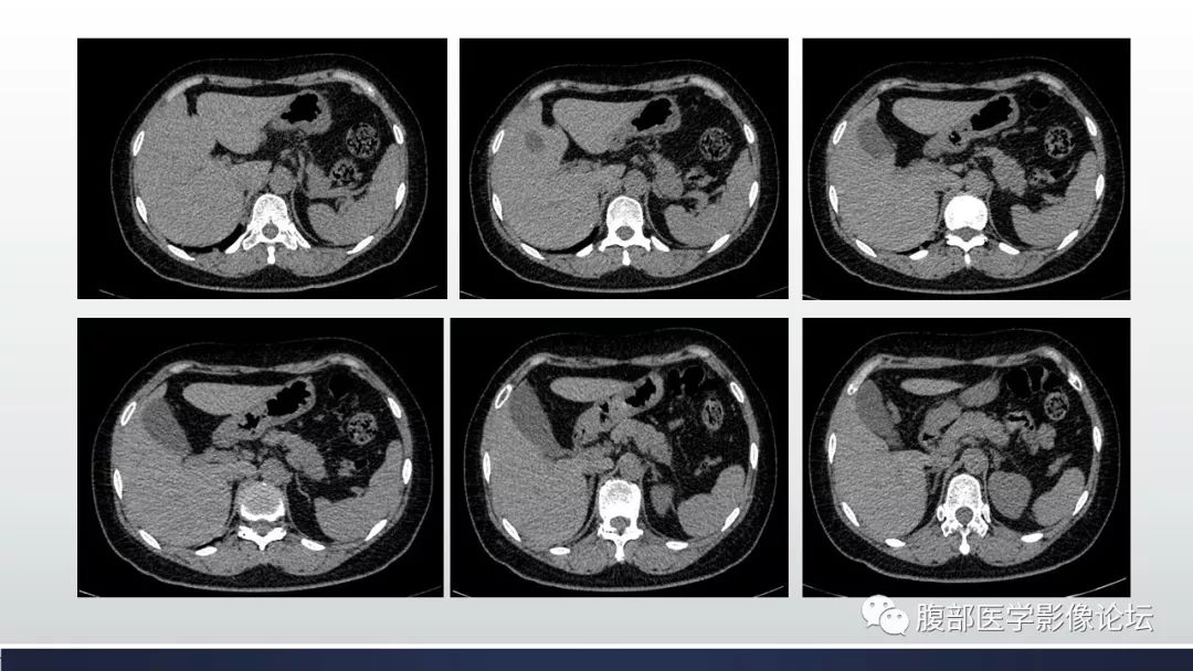 【病例】胰腺、肺结节病1例CT及MR影像