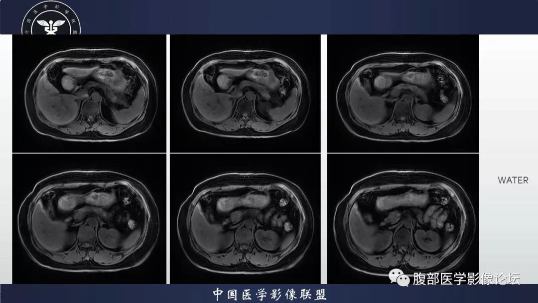 【病例】胰腺、肺结节病1例CT及MR影像