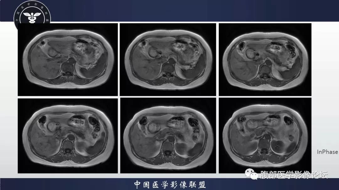【病例】胰腺、肺结节病1例CT及MR影像