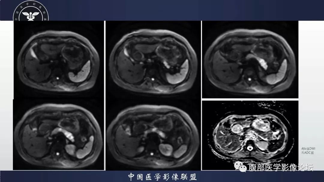 【病例】胰腺、肺结节病1例CT及MR影像