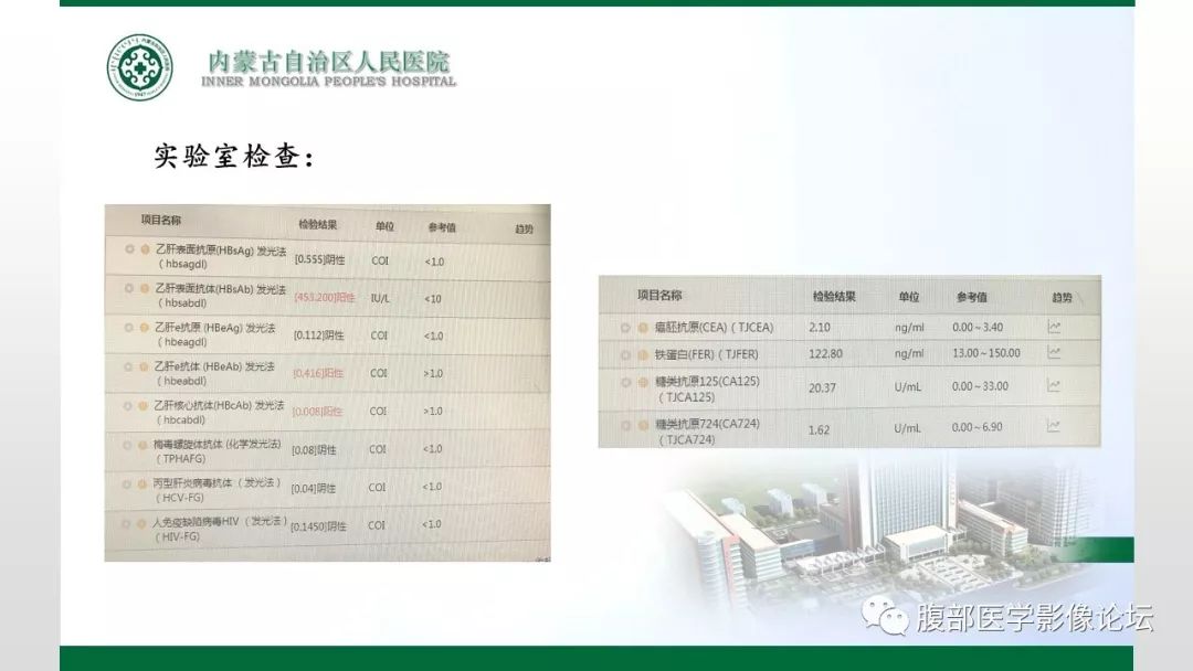 【病例】左肾子宫内膜异位囊肿1例CT及MR
