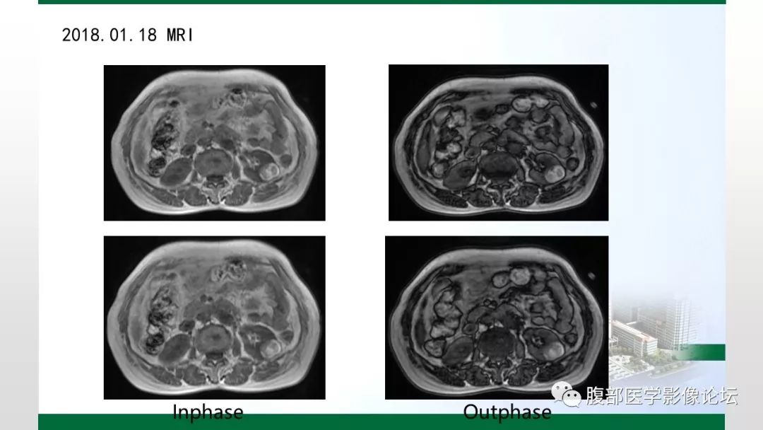 【病例】左肾子宫内膜异位囊肿1例CT及MR