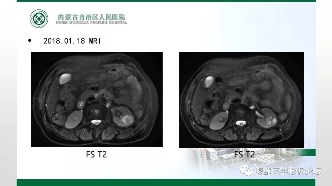 【病例】左肾子宫内膜异位囊肿1例CT及MR
