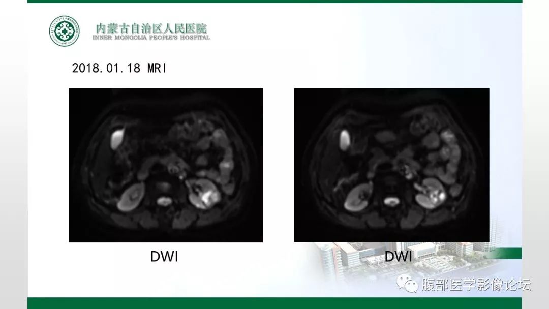 【病例】左肾子宫内膜异位囊肿1例CT及MR