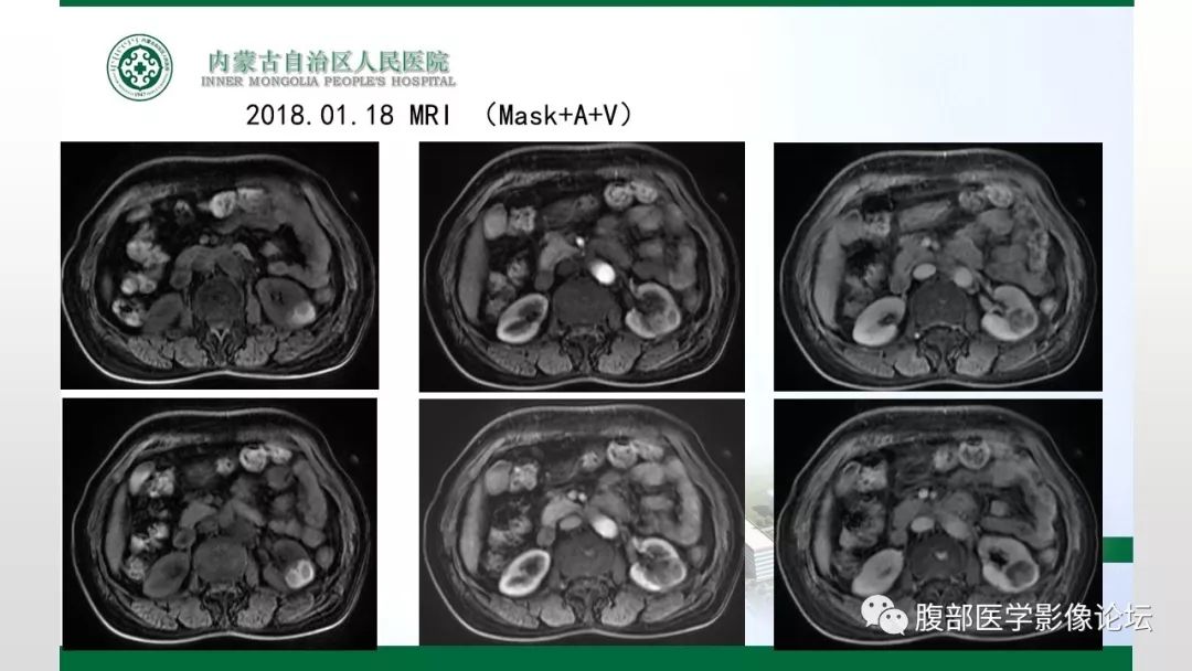 【病例】左肾子宫内膜异位囊肿1例CT及MR