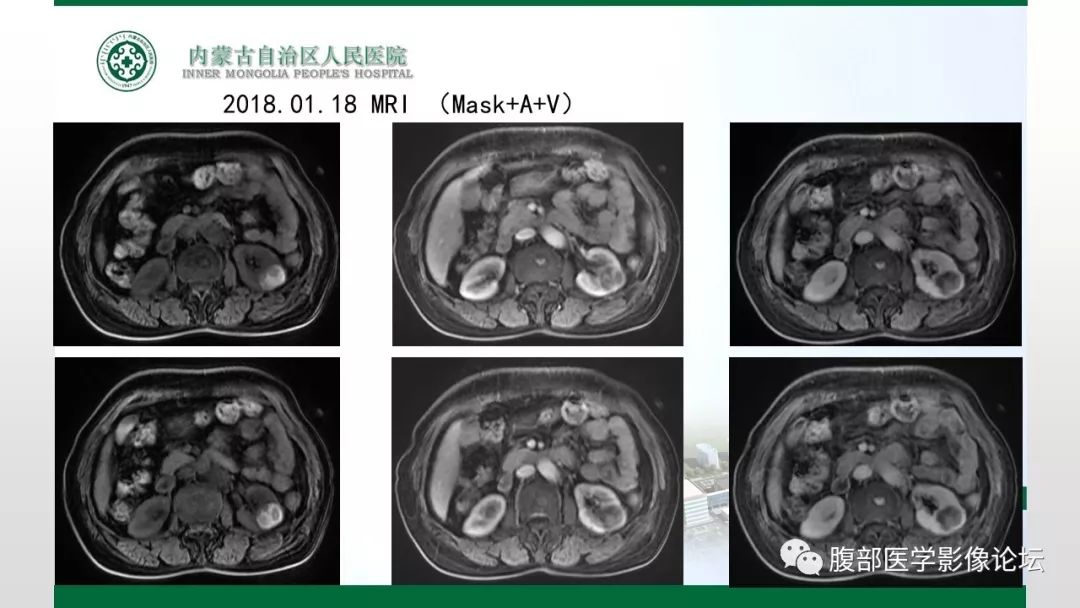【病例】左肾子宫内膜异位囊肿1例CT及MR