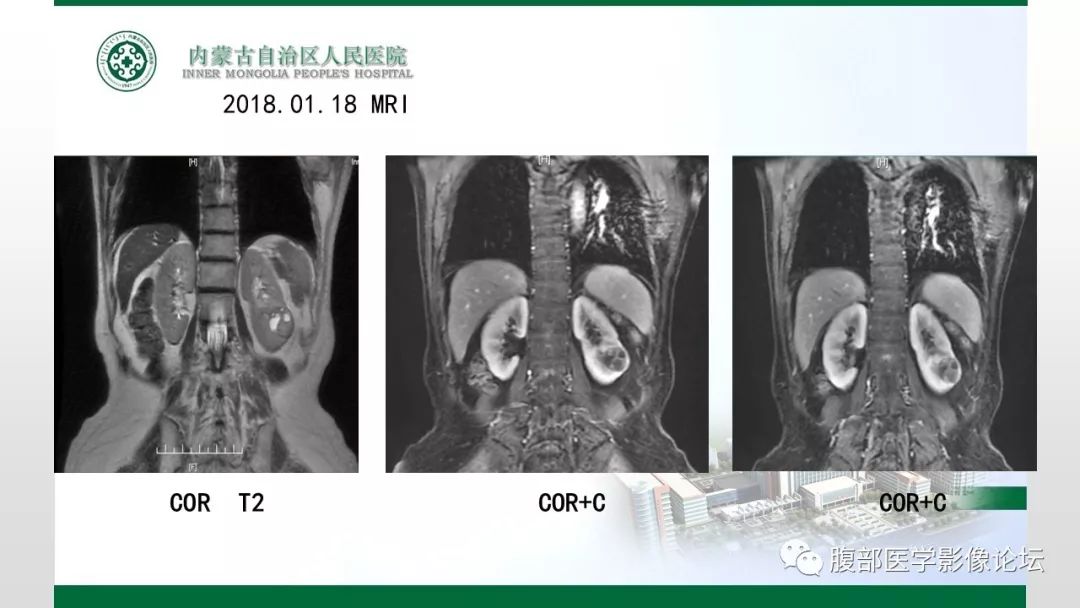 【病例】左肾子宫内膜异位囊肿1例CT及MR