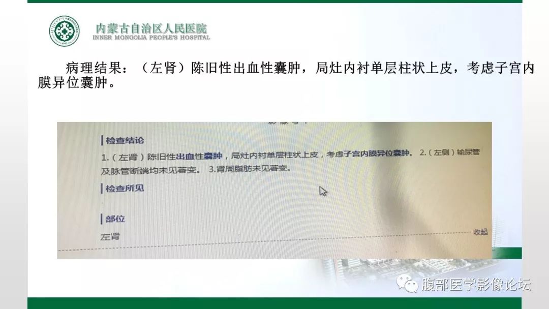 【病例】左肾子宫内膜异位囊肿1例CT及MR