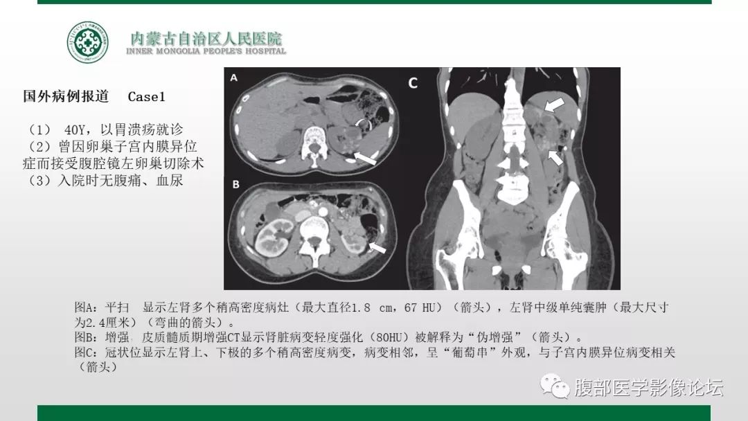【病例】左肾子宫内膜异位囊肿1例CT及MR