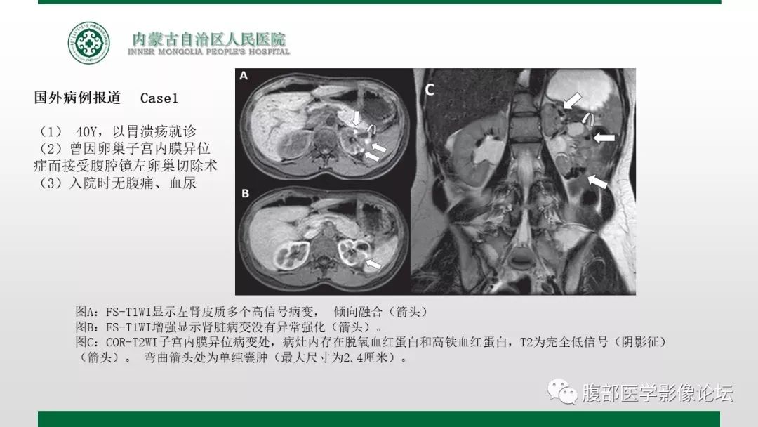 【病例】左肾子宫内膜异位囊肿1例CT及MR