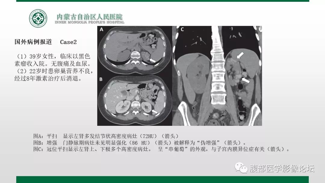 【病例】左肾子宫内膜异位囊肿1例CT及MR