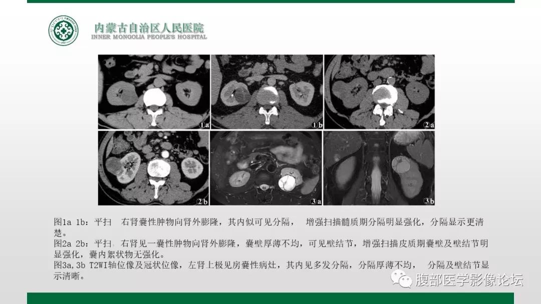 【病例】左肾子宫内膜异位囊肿1例CT及MR