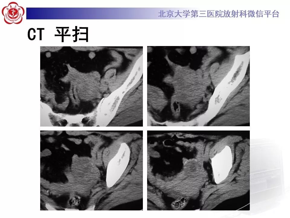 【PPT】卵巢甲状腺肿的影像