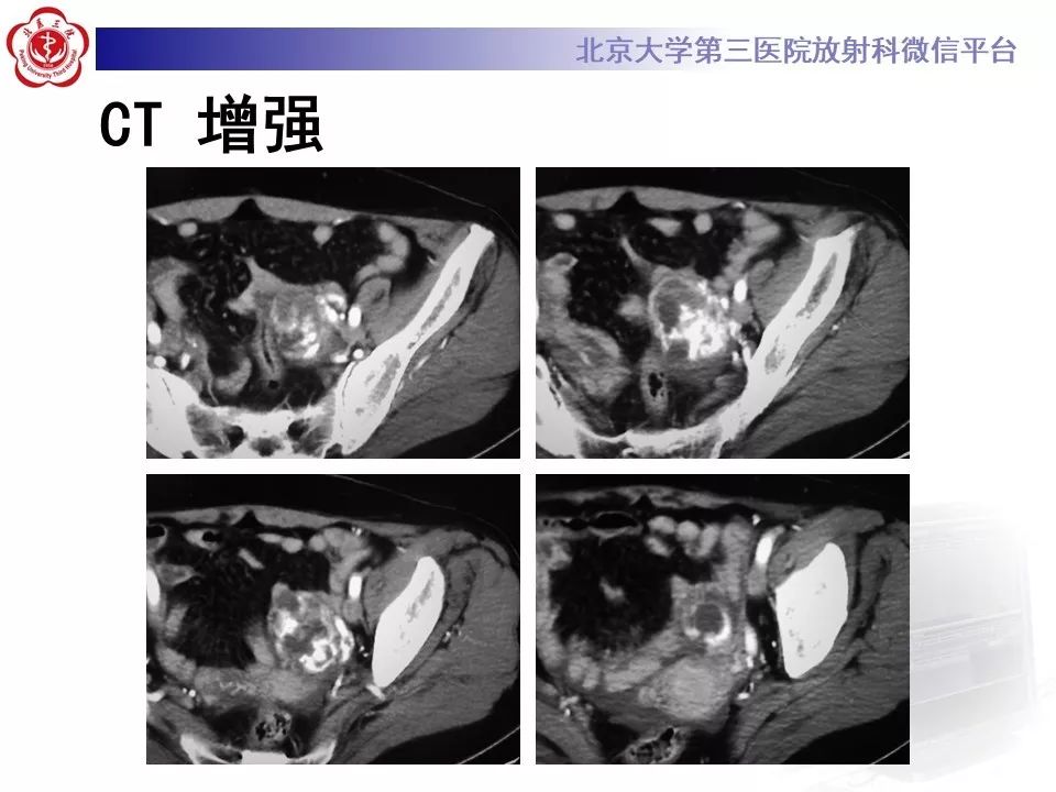 【PPT】卵巢甲状腺肿的影像
