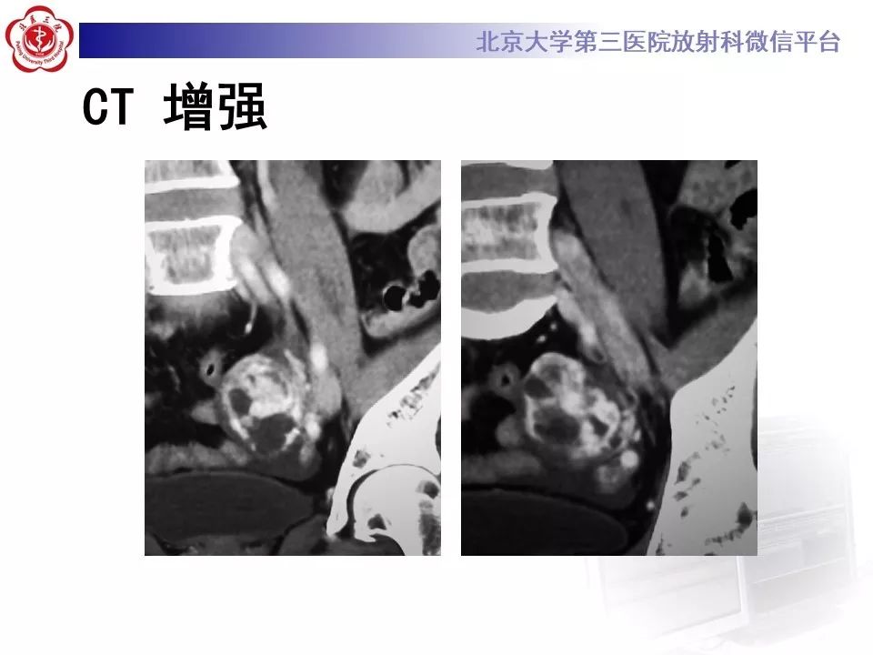 【PPT】卵巢甲状腺肿的影像
