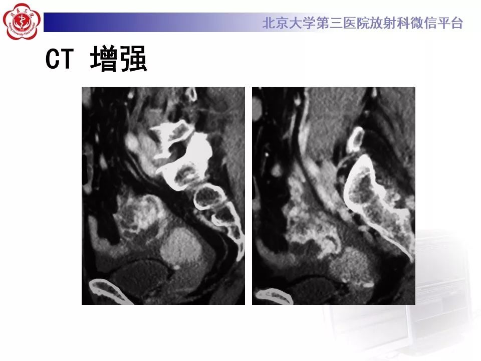 【PPT】卵巢甲状腺肿的影像