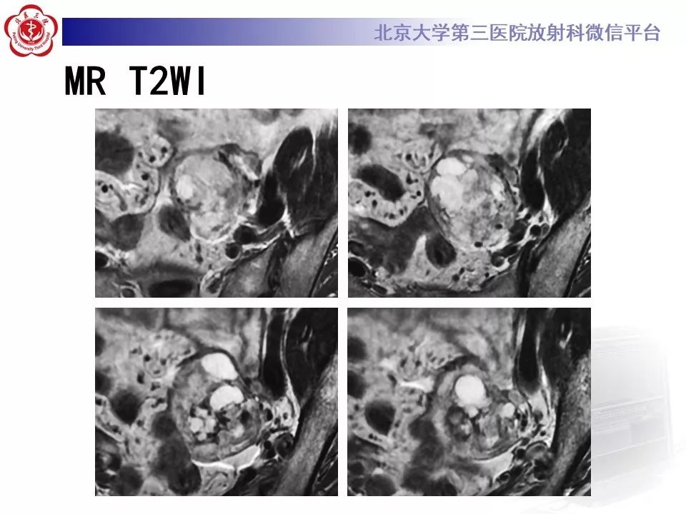 【PPT】卵巢甲状腺肿的影像