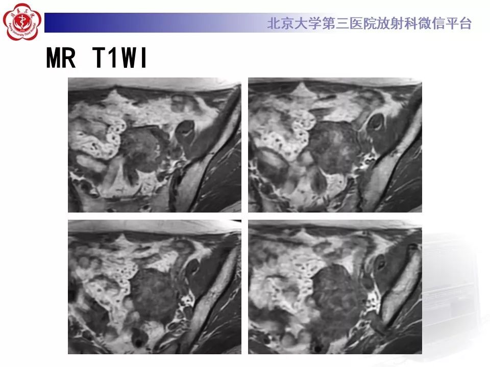 【PPT】卵巢甲状腺肿的影像